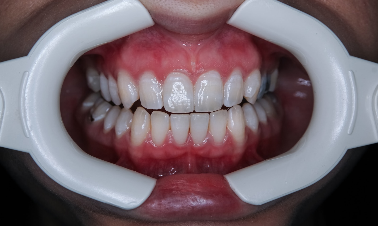 Strahlend weiße Zähne mit Zahnbleaching: Was Sie wissen sollten